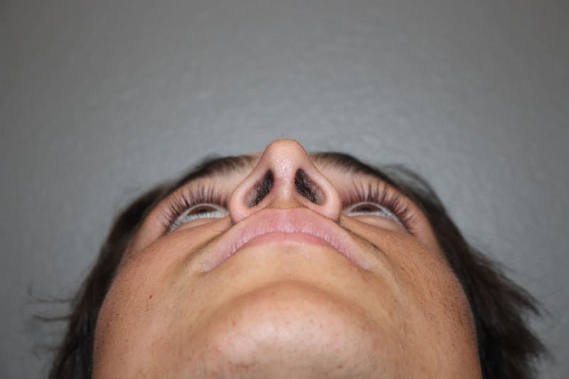 Rhinoplasty Before & After Gallery - Patient 146669486 - Image 12