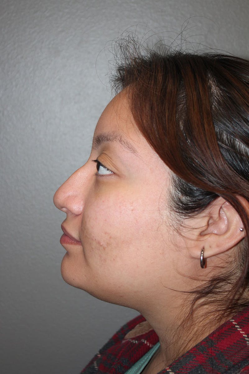 Rhinoplasty Before & After Gallery - Patient 146669485 - Image 7