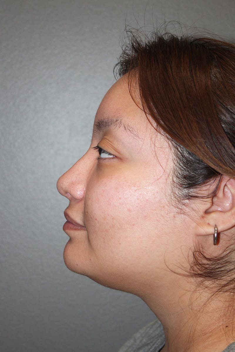 Rhinoplasty Before & After Gallery - Patient 146669485 - Image 8