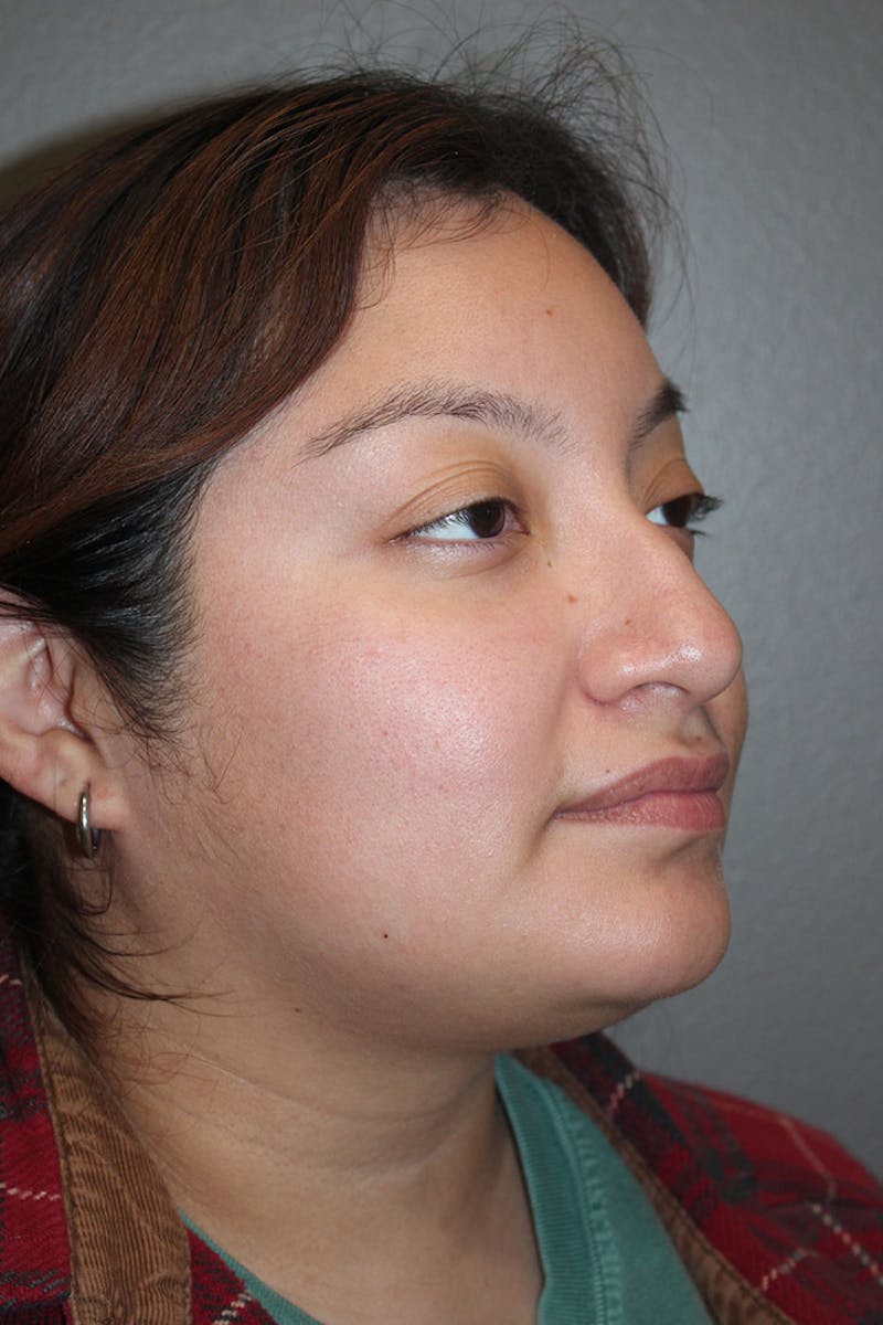 Rhinoplasty Before & After Gallery - Patient 146669485 - Image 9