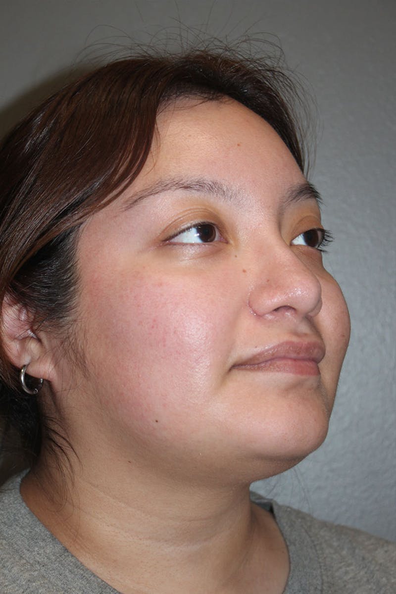 Rhinoplasty Before & After Gallery - Patient 146669485 - Image 10
