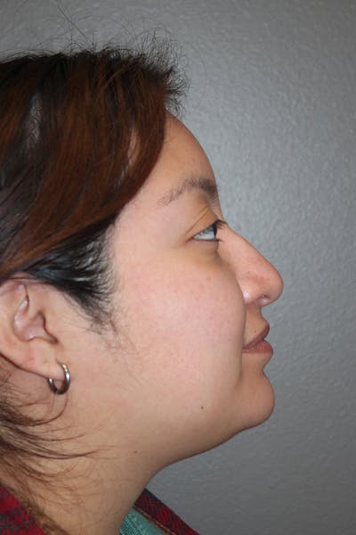 Rhinoplasty Before & After Gallery - Patient 146669485 - Image 1
