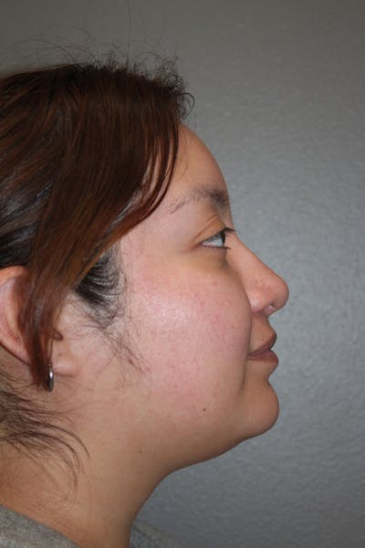 Rhinoplasty Before & After Gallery - Patient 146669485 - Image 2