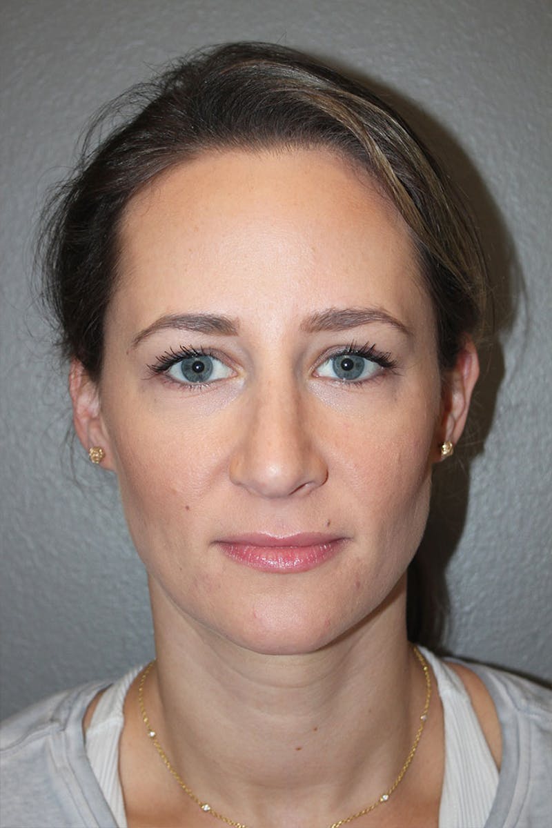 Rhinoplasty Before & After Gallery - Patient 146669484 - Image 4