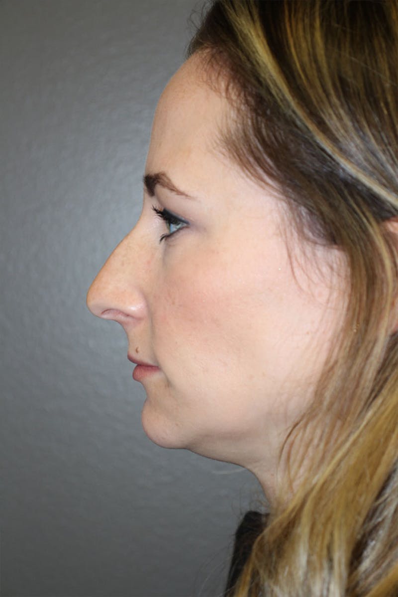 Rhinoplasty Before & After Gallery - Patient 146669484 - Image 5