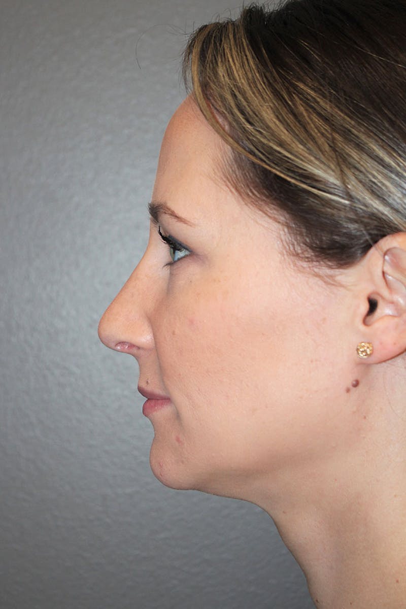 Rhinoplasty Before & After Gallery - Patient 146669484 - Image 6