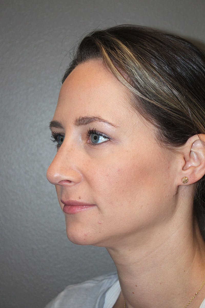 Rhinoplasty Before & After Gallery - Patient 146669484 - Image 8