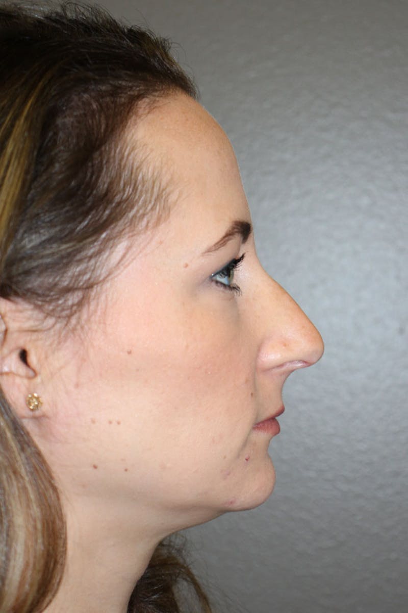 Rhinoplasty Before & After Gallery - Patient 146669484 - Image 1