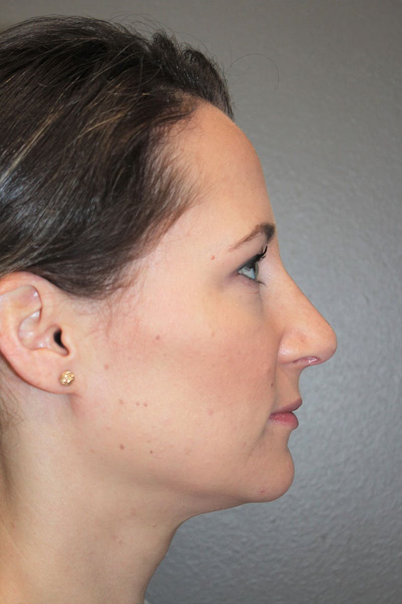 Rhinoplasty Before & After Gallery - Patient 146669484 - Image 2
