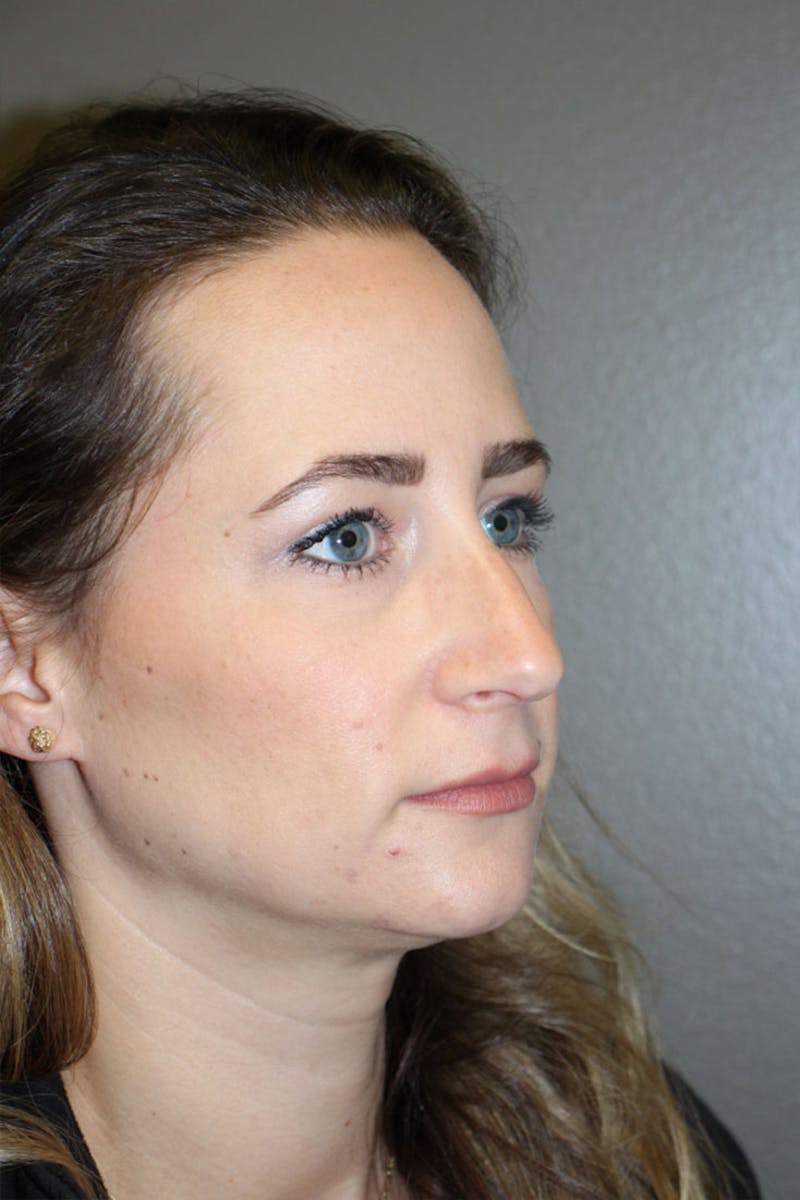 Rhinoplasty Before & After Gallery - Patient 146669484 - Image 9