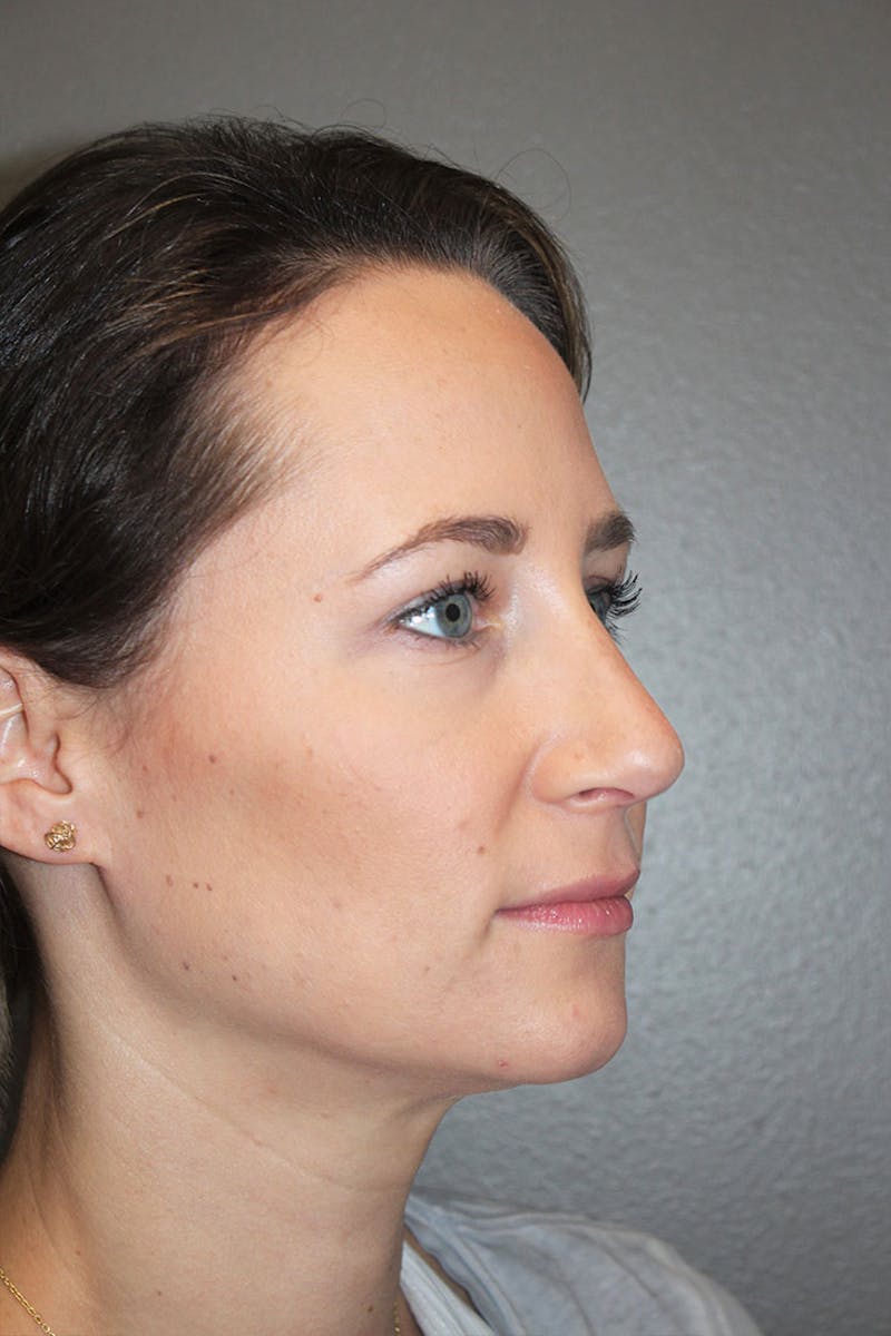 Rhinoplasty Before & After Gallery - Patient 146669484 - Image 10