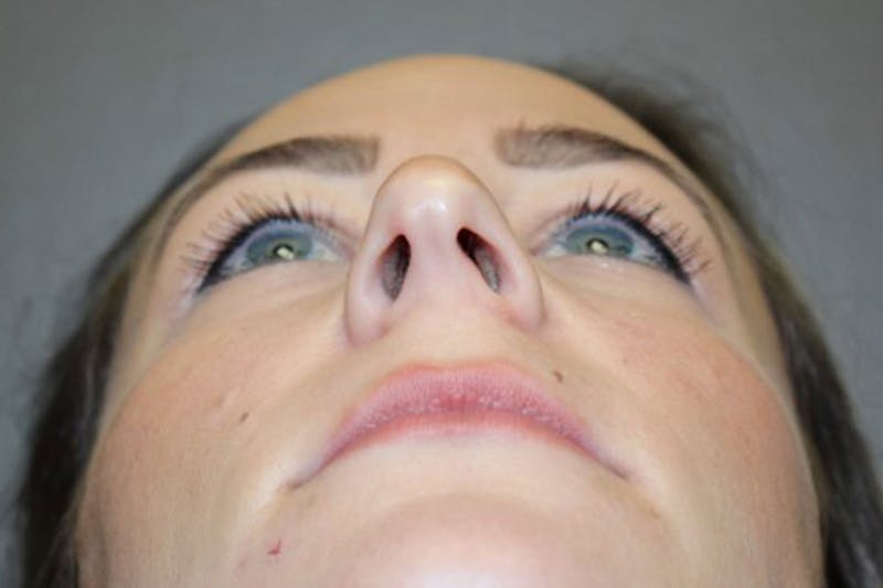 Rhinoplasty Before & After Gallery - Patient 146669484 - Image 11