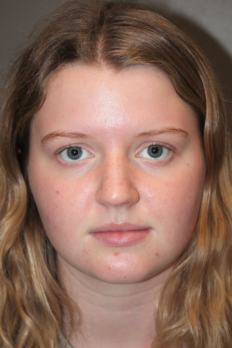 Rhinoplasty Before & After Gallery - Patient 146669483 - Image 3