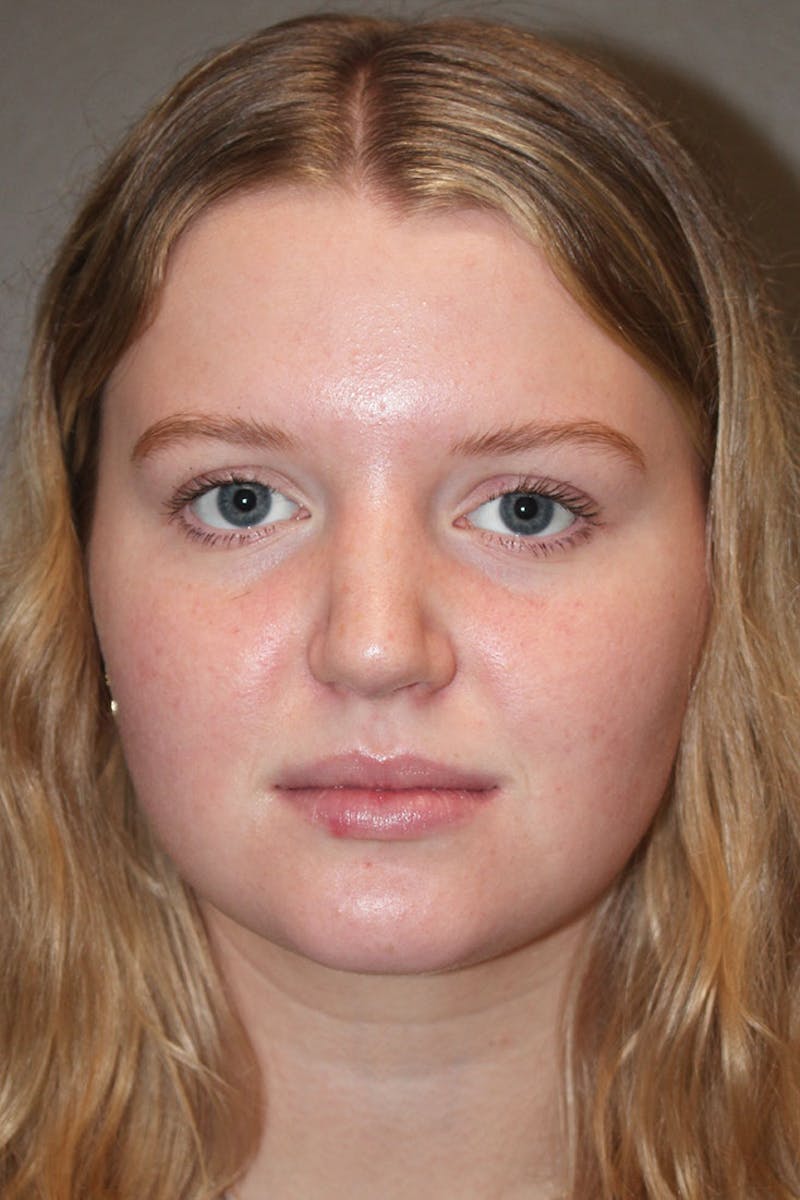Rhinoplasty Before & After Gallery - Patient 146669483 - Image 4