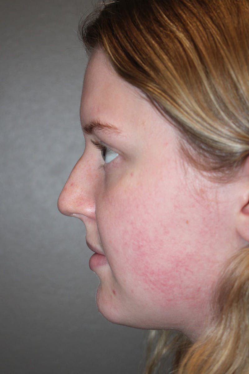 Rhinoplasty Before & After Gallery - Patient 146669483 - Image 5