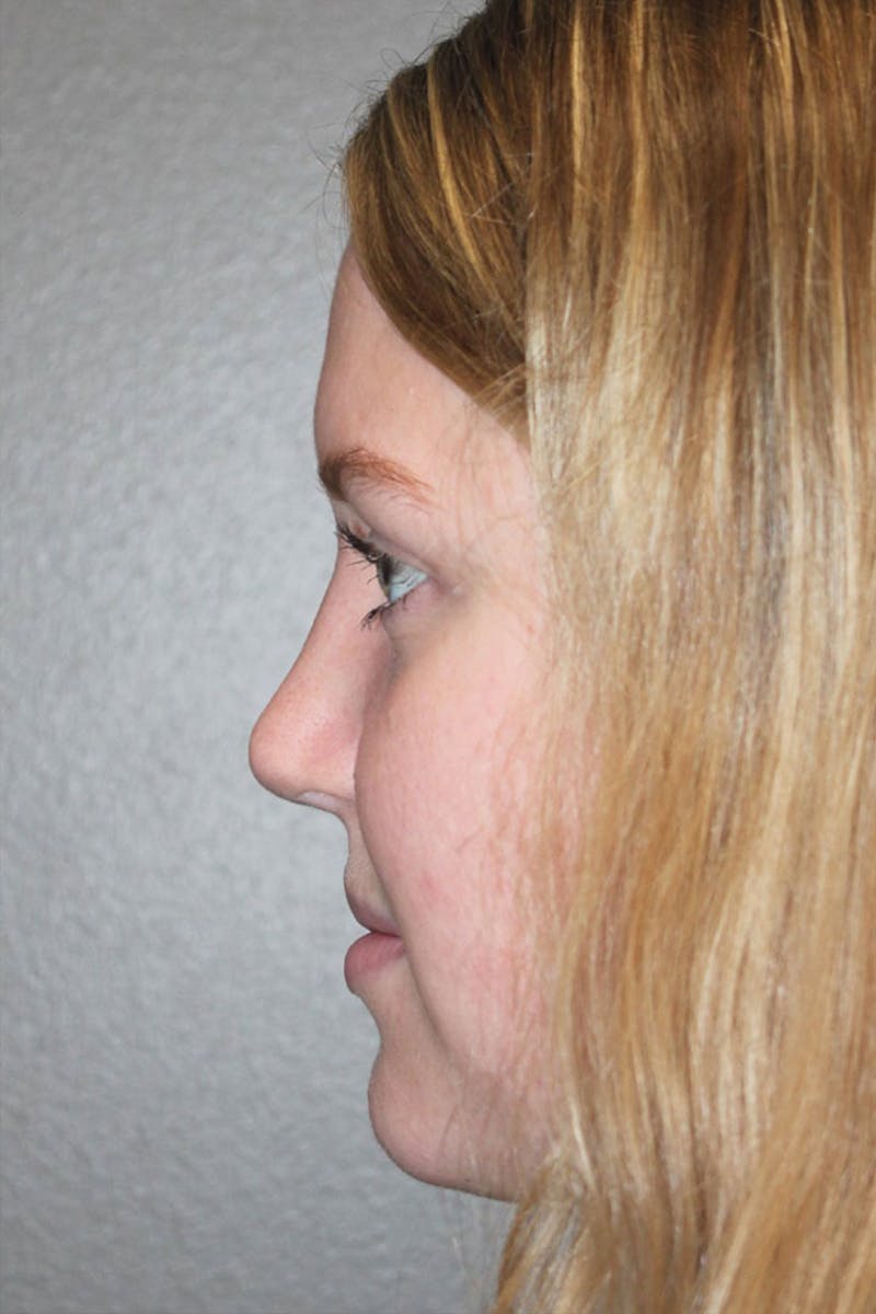 Rhinoplasty Before & After Gallery - Patient 146669483 - Image 6