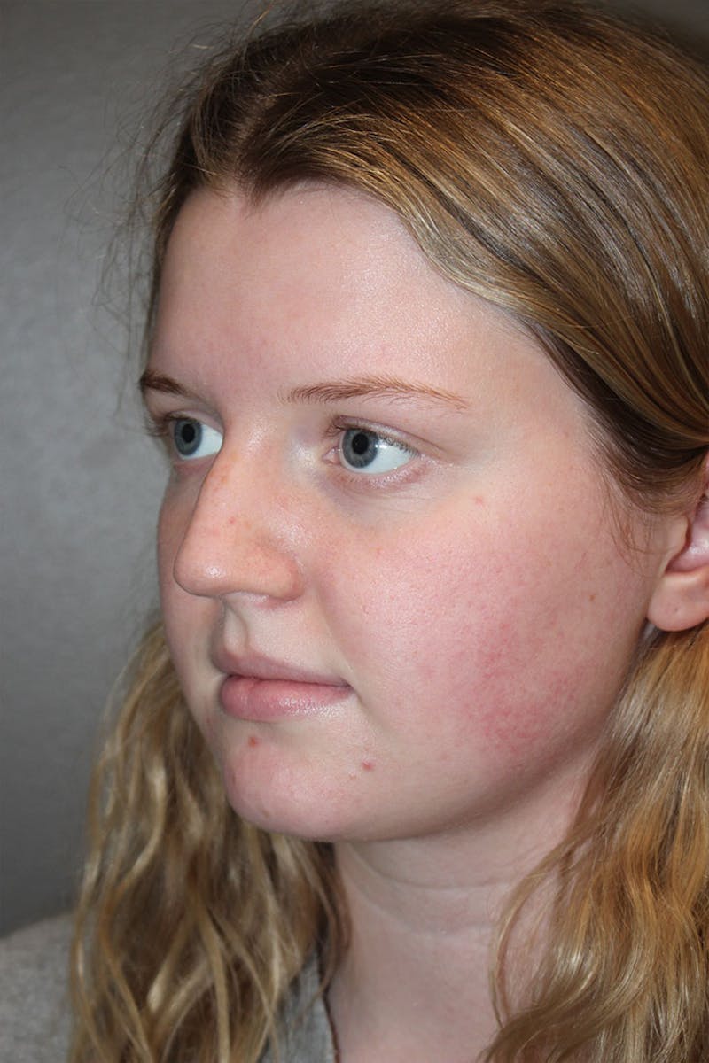 Rhinoplasty Before & After Gallery - Patient 146669483 - Image 7