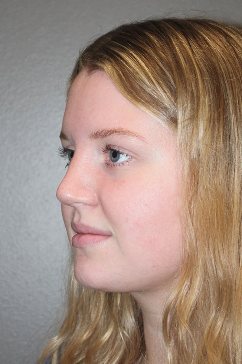 Rhinoplasty Before & After Gallery - Patient 146669483 - Image 8