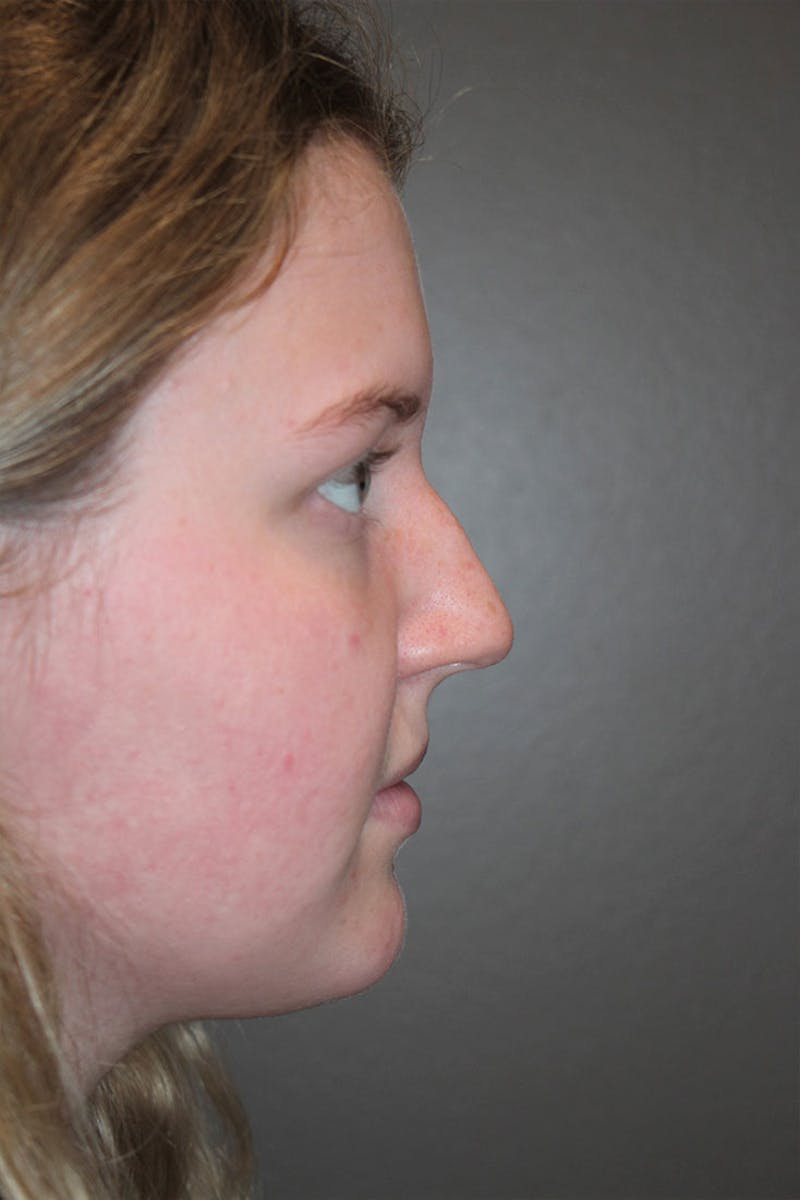 Rhinoplasty Before & After Gallery - Patient 146669483 - Image 1