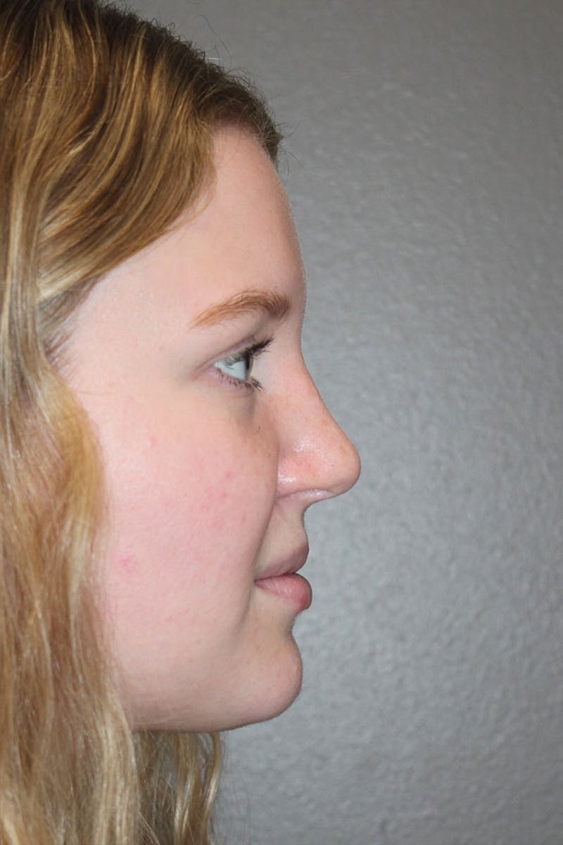 Rhinoplasty Before & After Gallery - Patient 146669483 - Image 2