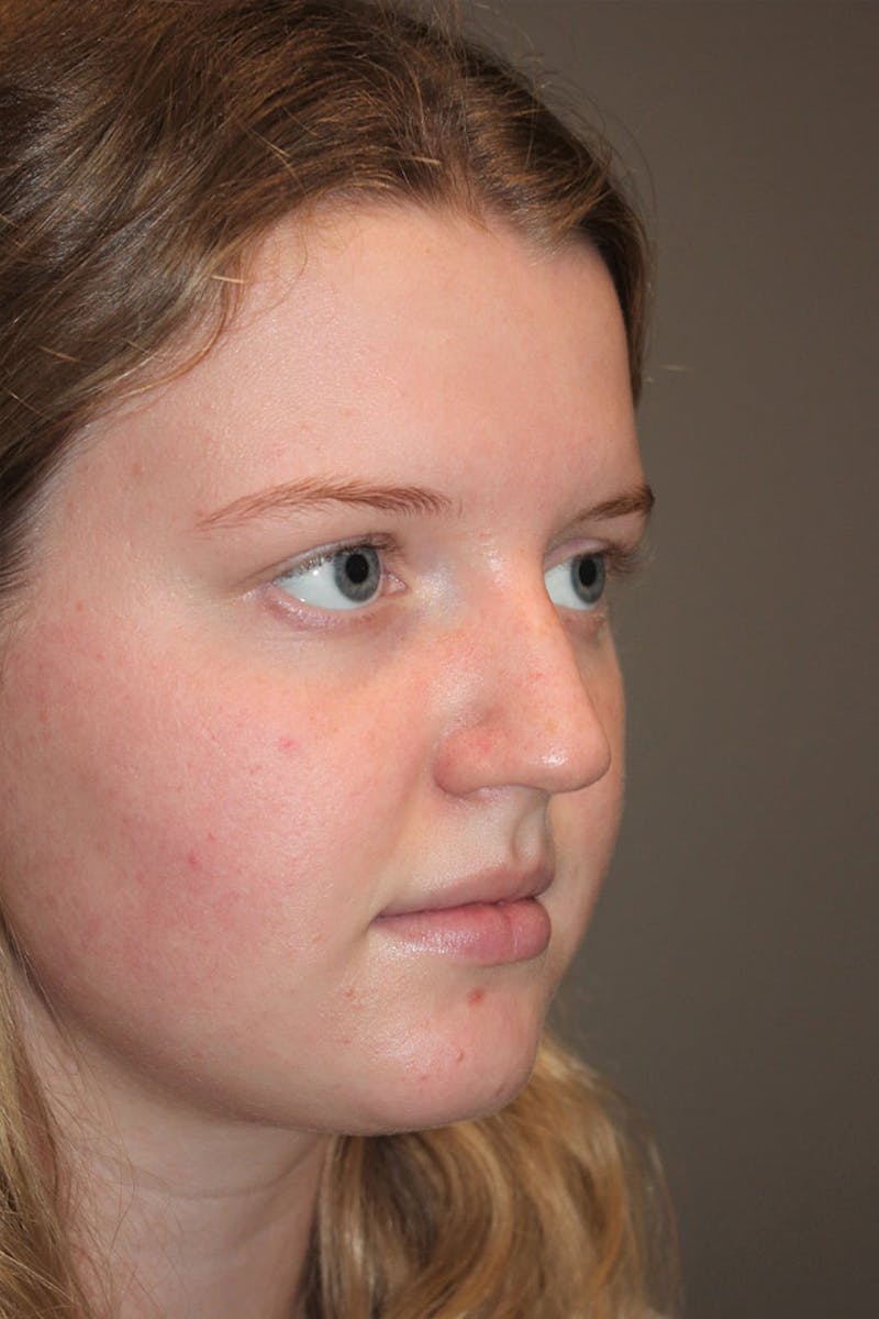 Rhinoplasty Before & After Gallery - Patient 146669483 - Image 9