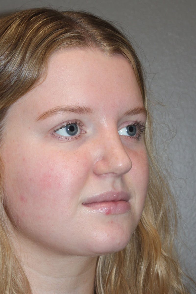 Rhinoplasty Before & After Gallery - Patient 146669483 - Image 10