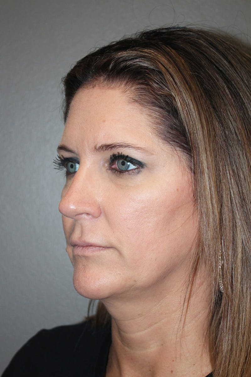 Rhinoplasty Before & After Gallery - Patient 146669563 - Image 6