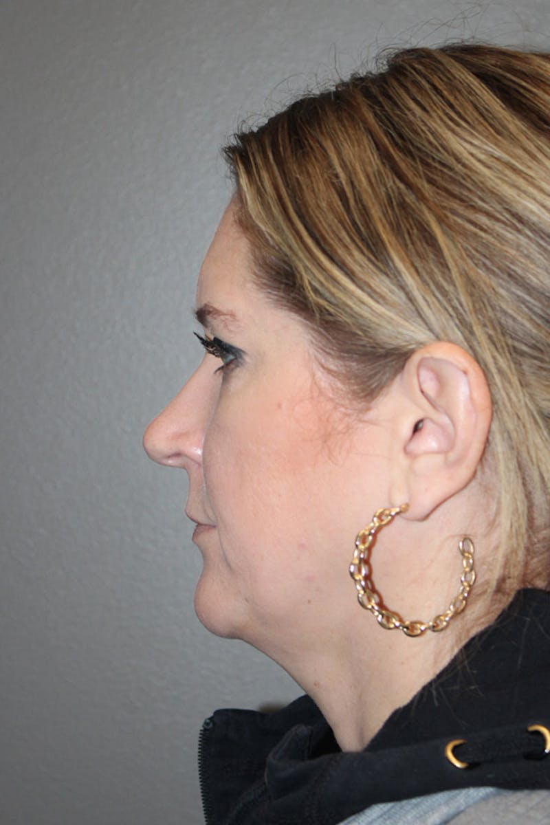 Rhinoplasty Before & After Gallery - Patient 146669563 - Image 7