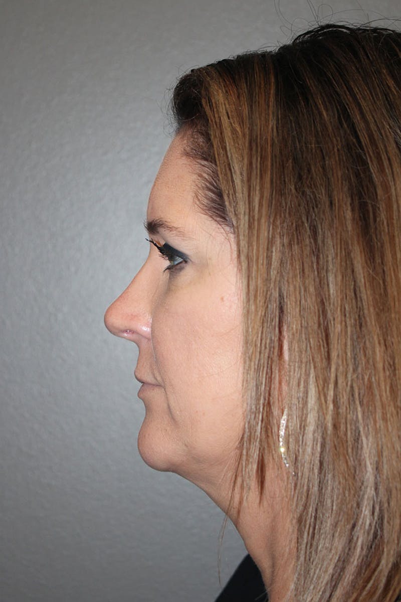 Rhinoplasty Before & After Gallery - Patient 146669563 - Image 8