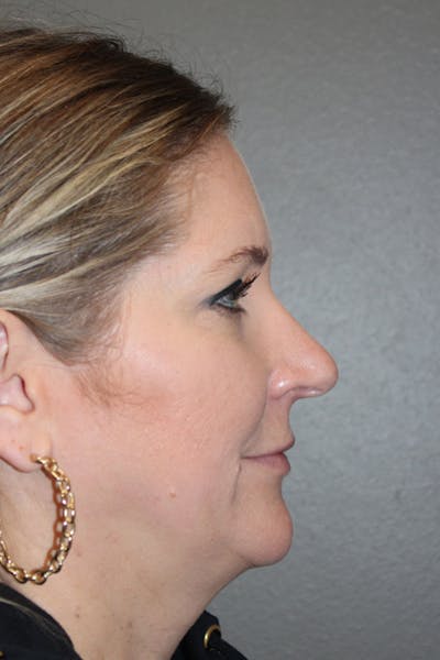 Rhinoplasty Before & After Gallery - Patient 146669563 - Image 1