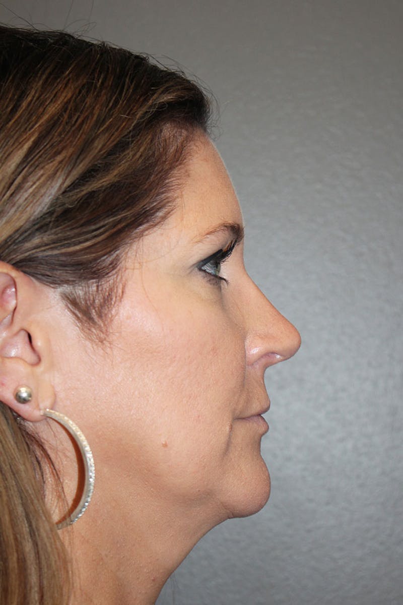 Rhinoplasty Before & After Gallery - Patient 146669563 - Image 2
