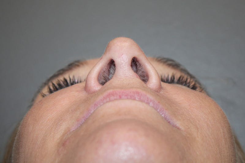Rhinoplasty Before & After Gallery - Patient 146669561 - Image 12