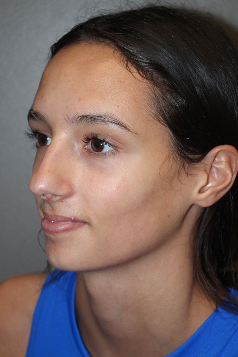 Rhinoplasty Before & After Gallery - Patient 146669560 - Image 5