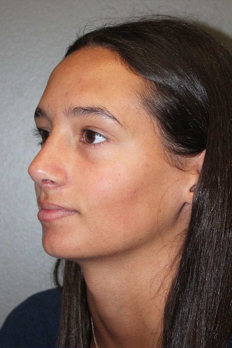 Rhinoplasty Before & After Gallery - Patient 146669560 - Image 6