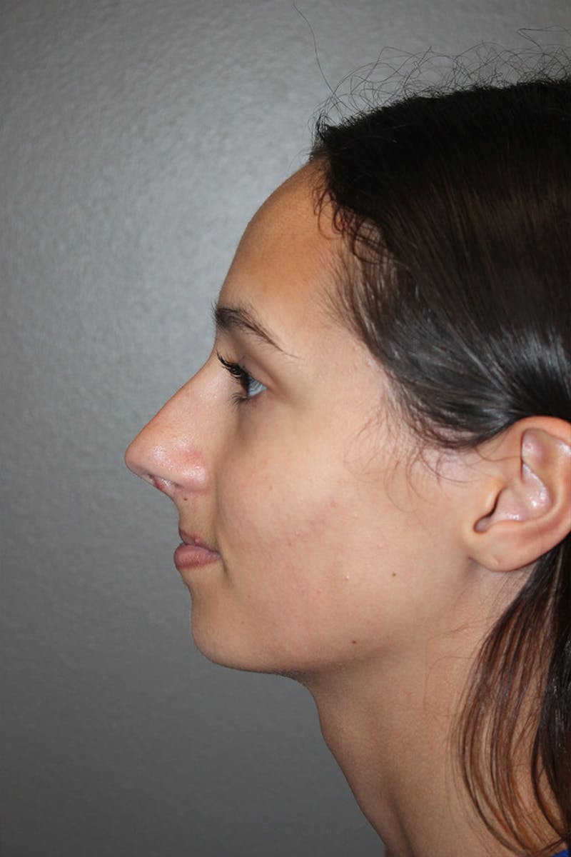 Rhinoplasty Before & After Gallery - Patient 146669560 - Image 7