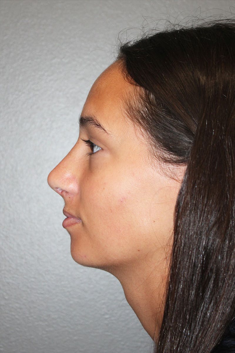 Rhinoplasty Before & After Gallery - Patient 146669560 - Image 8
