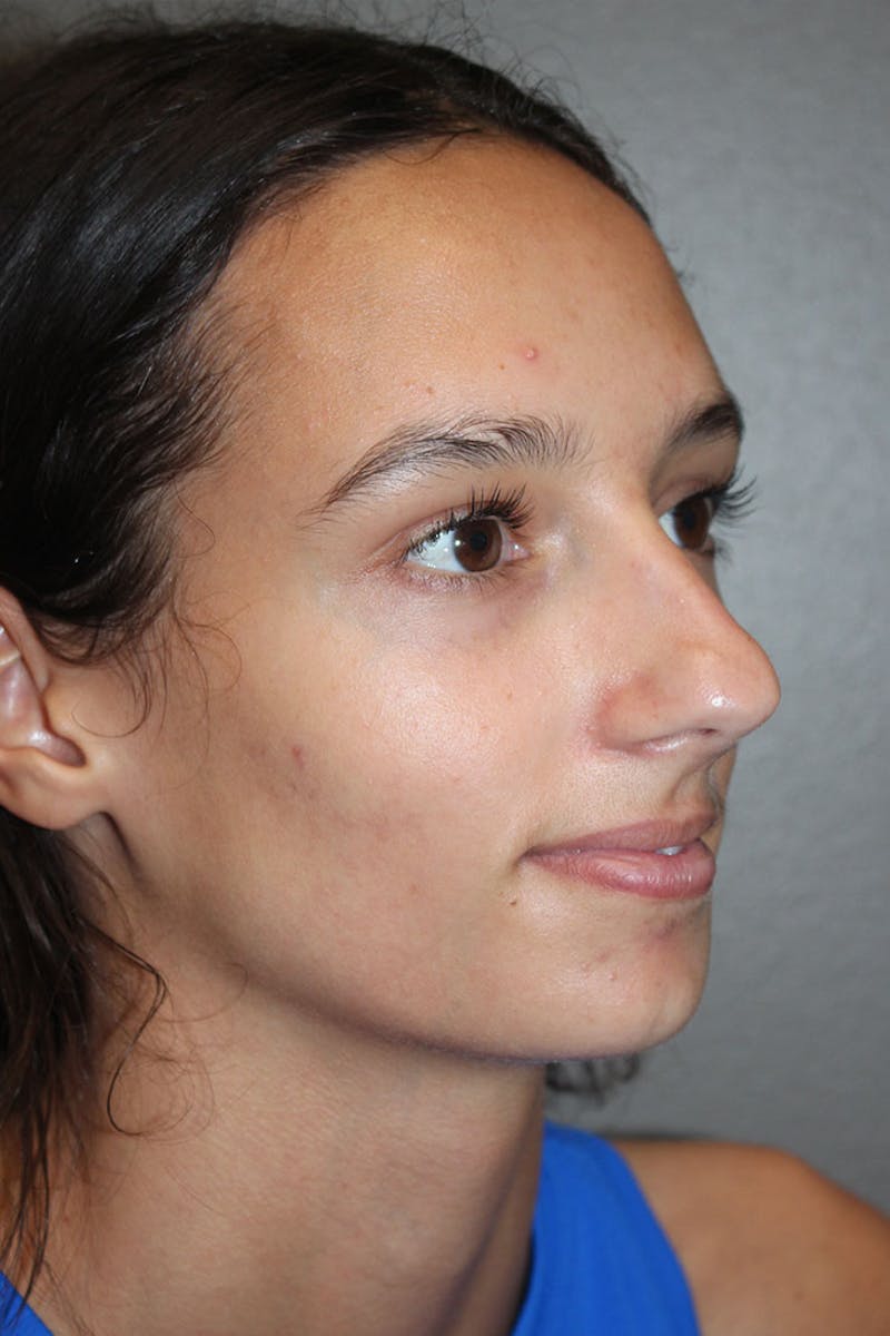 Rhinoplasty Before & After Gallery - Patient 146669560 - Image 9