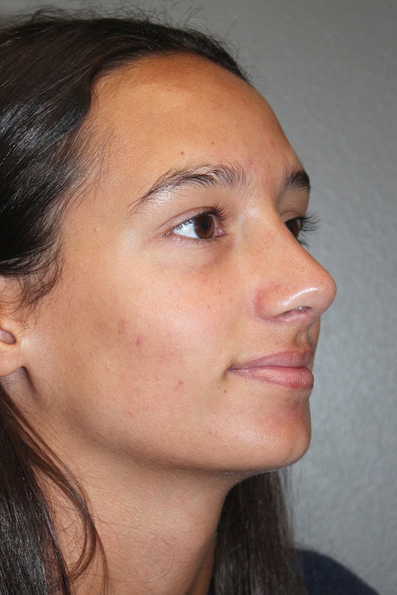 Rhinoplasty Before & After Gallery - Patient 146669560 - Image 10