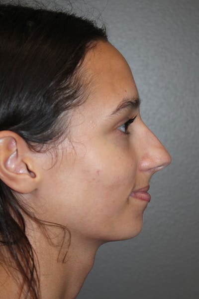 Rhinoplasty Before & After Gallery - Patient 146669560 - Image 1