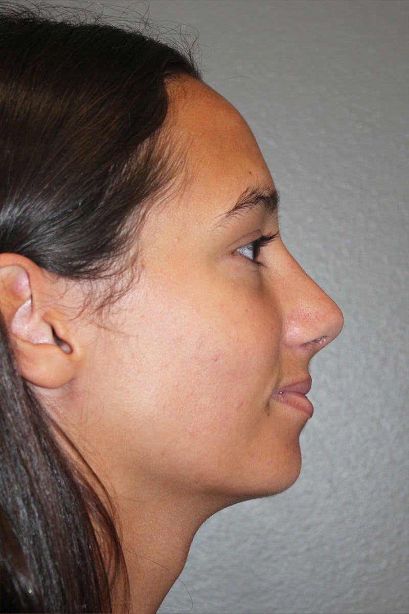 Rhinoplasty Before & After Gallery - Patient 146669560 - Image 2