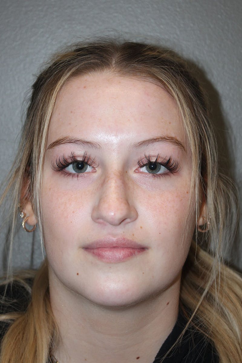 Rhinoplasty Before & After Gallery - Patient 146669559 - Image 3