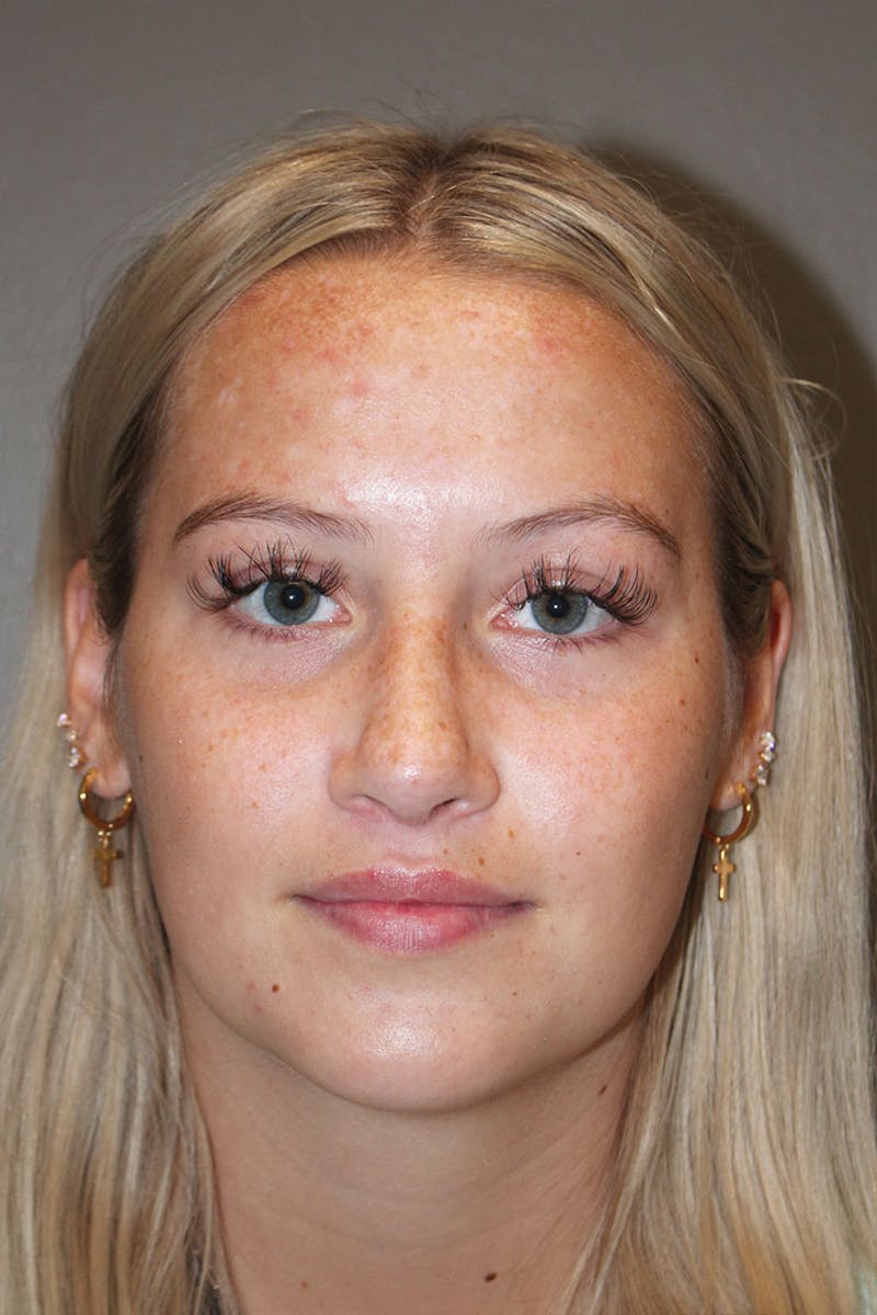 Rhinoplasty Before & After Gallery - Patient 146669559 - Image 4
