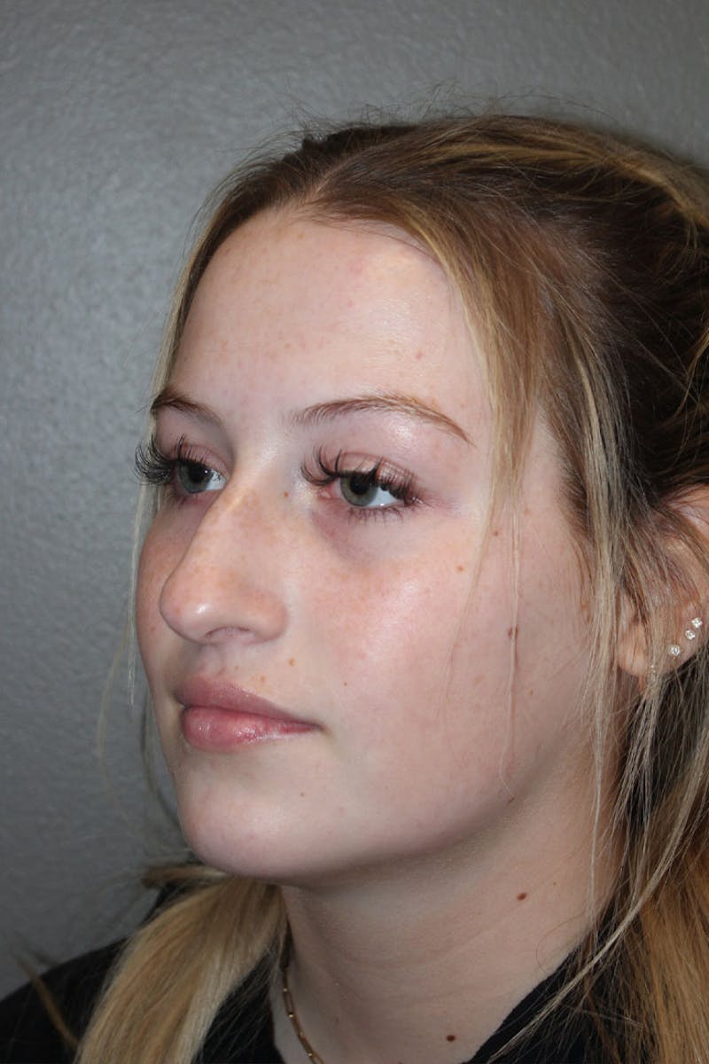 Rhinoplasty Before & After Gallery - Patient 146669559 - Image 5