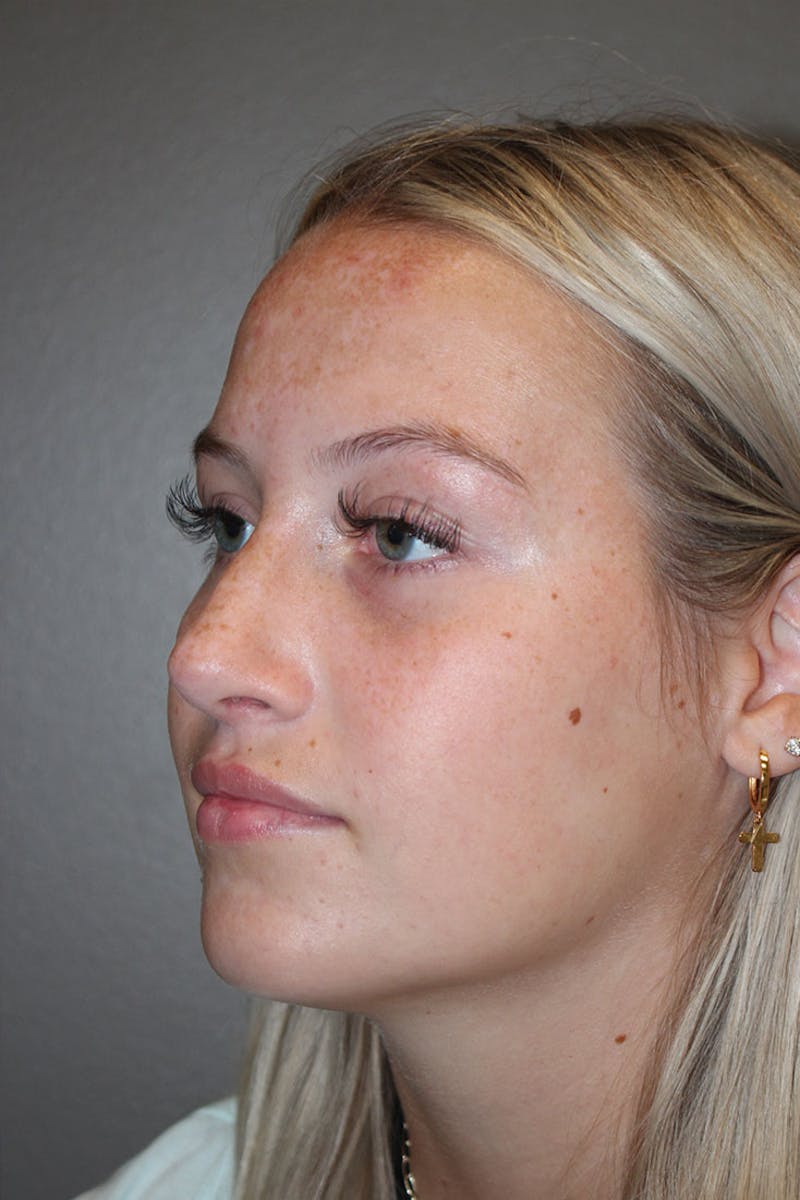 Rhinoplasty Before & After Gallery - Patient 146669559 - Image 6