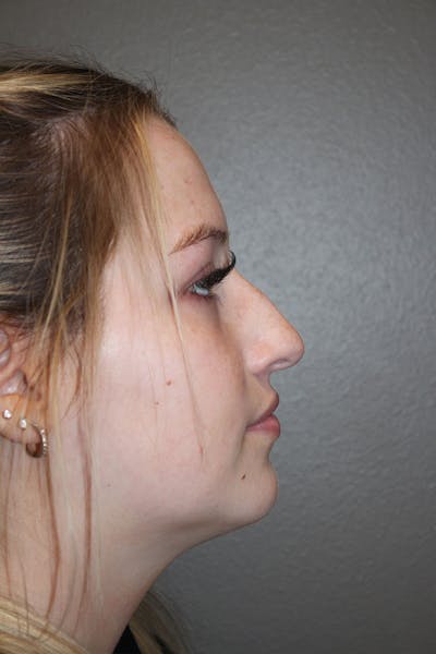 Rhinoplasty Before & After Gallery - Patient 146669559 - Image 1
