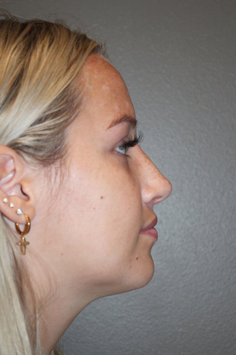 Rhinoplasty Before & After Gallery - Patient 146669559 - Image 2