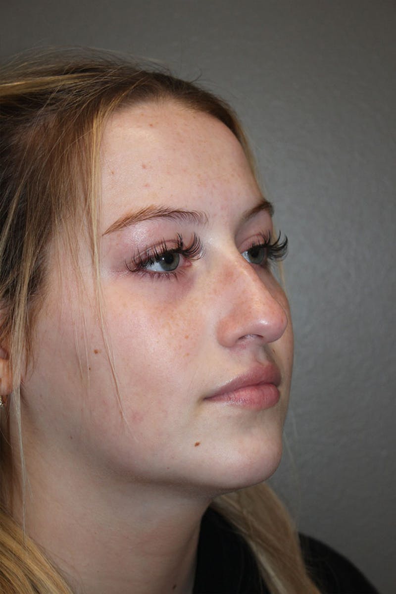 Rhinoplasty Before & After Gallery - Patient 146669559 - Image 7