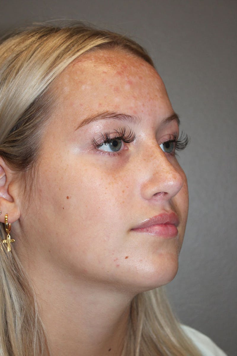 Rhinoplasty Before & After Gallery - Patient 146669559 - Image 8