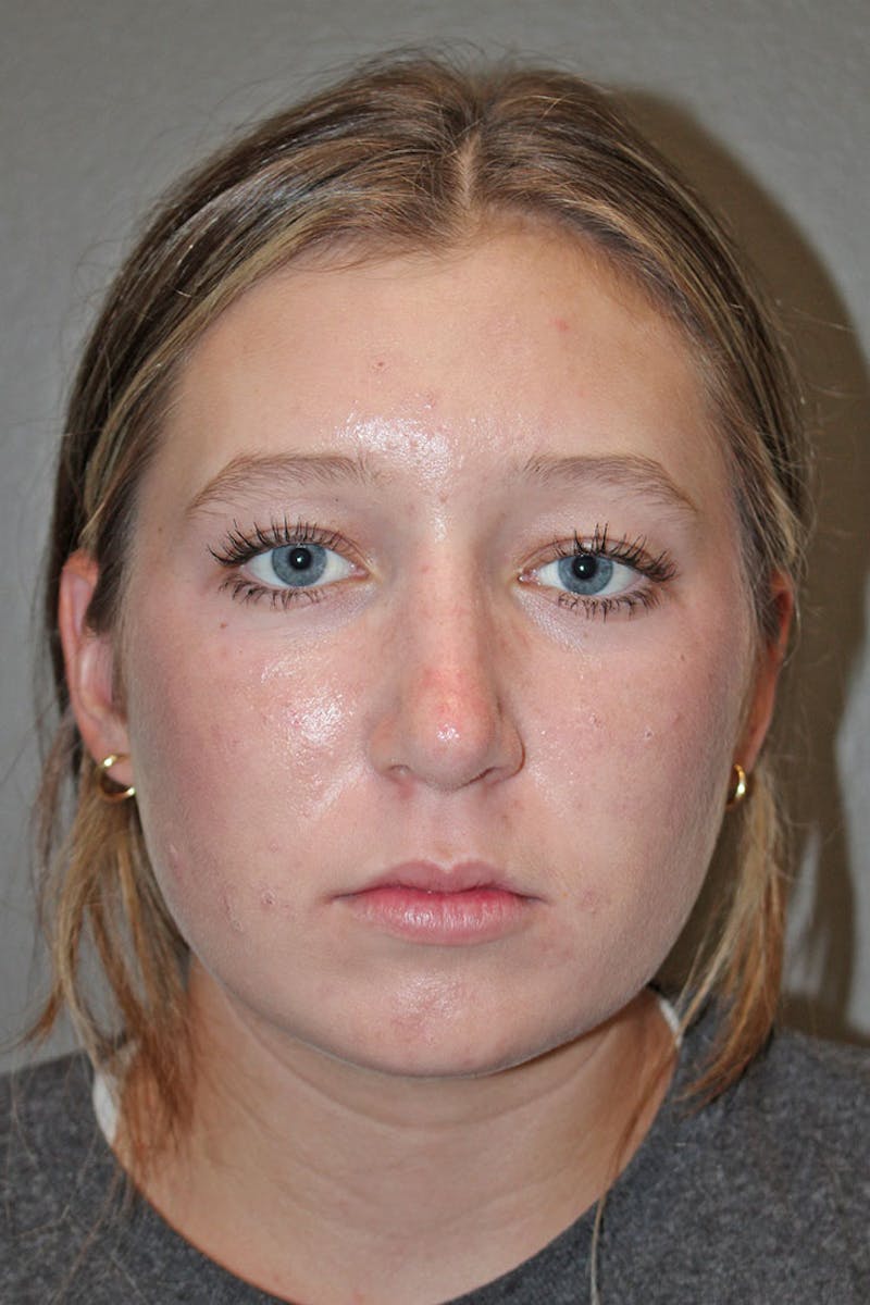 Rhinoplasty Before & After Gallery - Patient 146669558 - Image 4