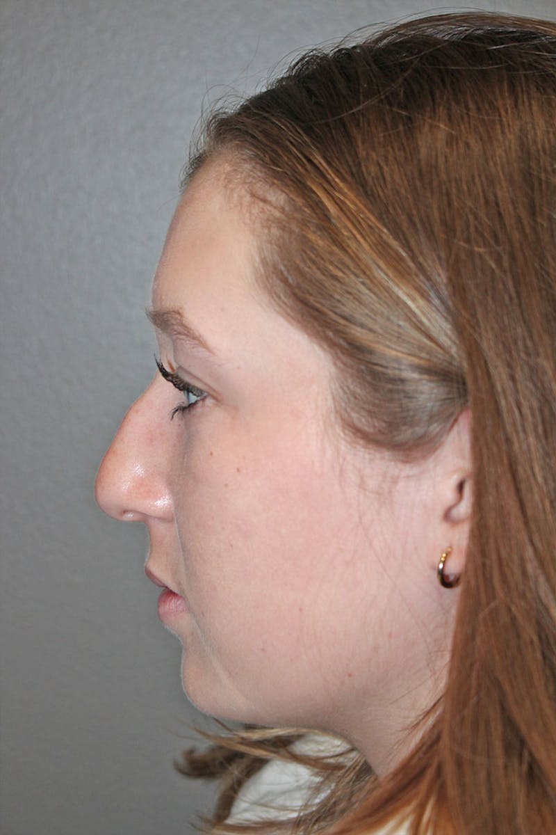 Rhinoplasty Before & After Gallery - Patient 146669558 - Image 5